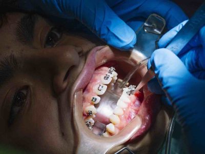 Teenager gets orthodontic treatment
